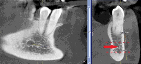 Рисунок 3. КЛКТ Сагиттальныи и коронарныи реформаты переднего отдела нижнеи челюсти..jpg