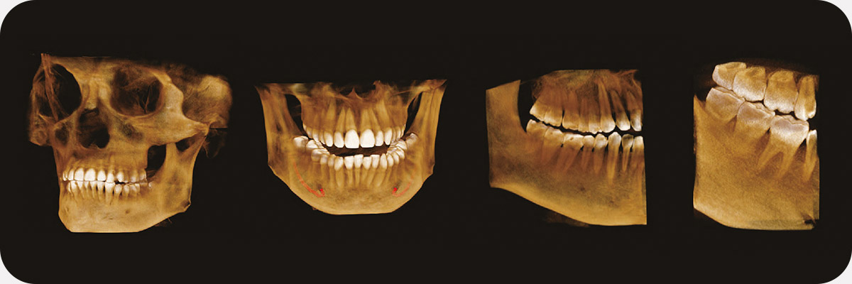 Пример 3D исследования дентального компьютерного 3D томографа Volux 55 Genoray.jpg