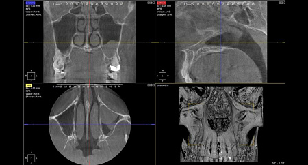 Owandy I-Max Touch 3D Ceph – Конусно-лучевой томограф 9х8