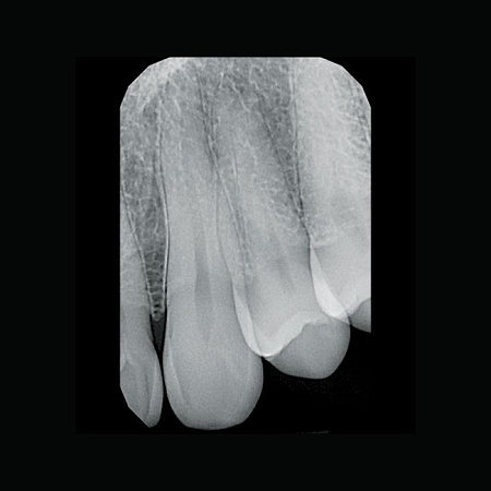 KaVo Gendex GXS-700 - система компьютерной радиовизиографии (сенсор №1)