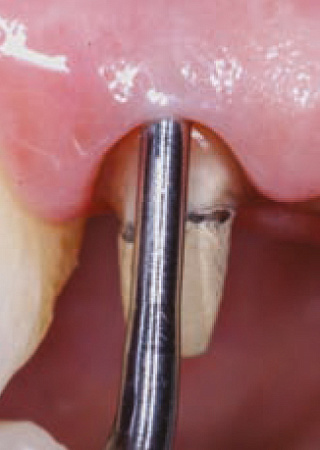 Acteon PMS3 – Насадка для скайлера