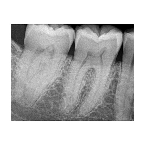 Carestream Kodak RVG 6200 - радиовизиограф